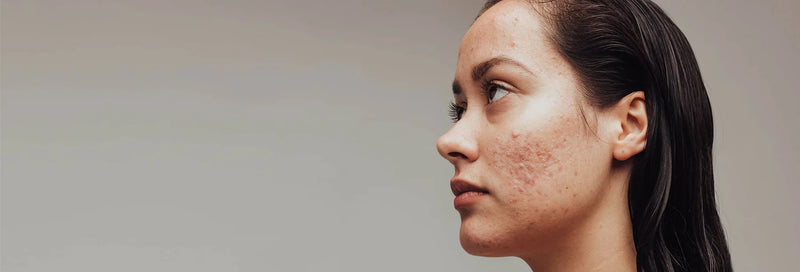 Acne & Breakouts